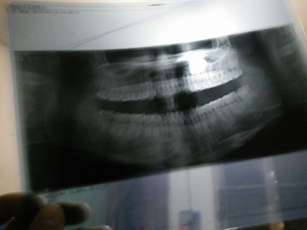 左下最里面长了个智齿,去县医院医生拔不了,让