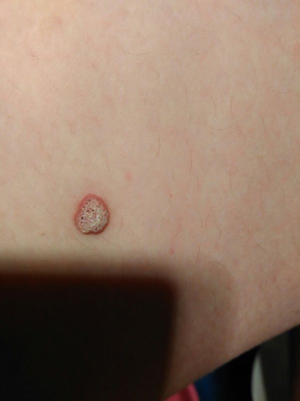 腿上长了一个增生的小球,不知道是什么,之前是