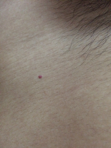 请问我这个是什么病啊?胳膊上,大腿上都会起这