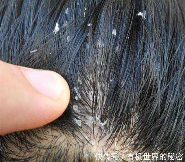 头皮油能抠下灰泥,说明几万螨虫扎根毛孔,再不
