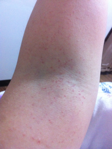 手臂上好多红点点,不痒,特别是洗好澡后特别明