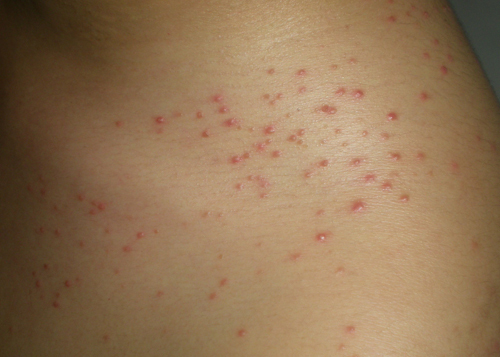 folliculitis)是由马拉色菌所致的毛囊炎,曾称糠秕孢子菌毛囊炎