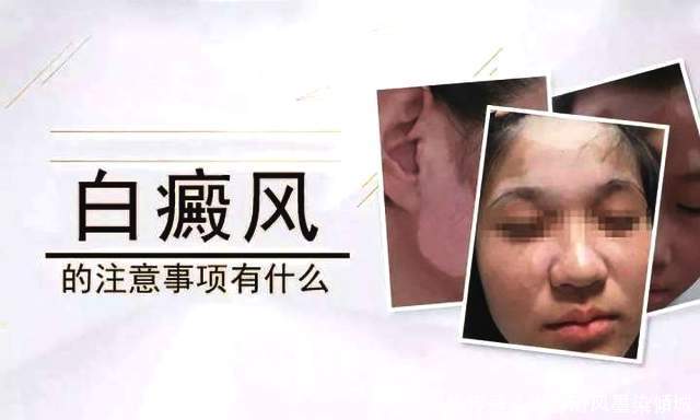 白癜风的常识中有哪些经常被人误解