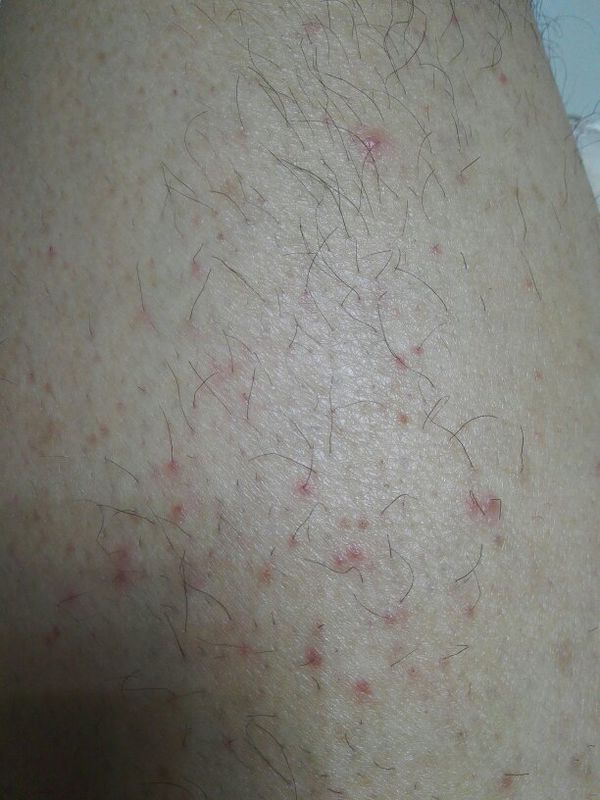 请教我大腿上面很痒,毛囊都根部发红,很痒,有的