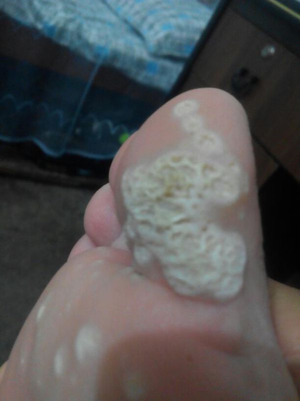 皮肤病? 脚气,真菌还是细菌?看图!不痒不疼,有