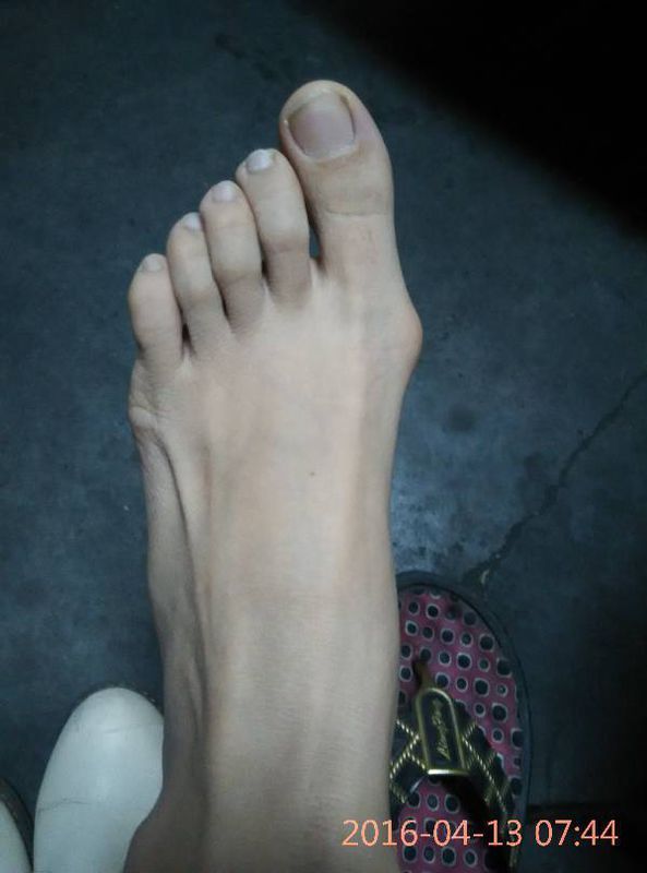 我的脚趾最近会有些疼痛,大脚趾突出,这个有影