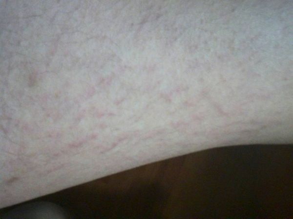 我的大腿内侧有紫红色条纹,没什么症状,可我妈
