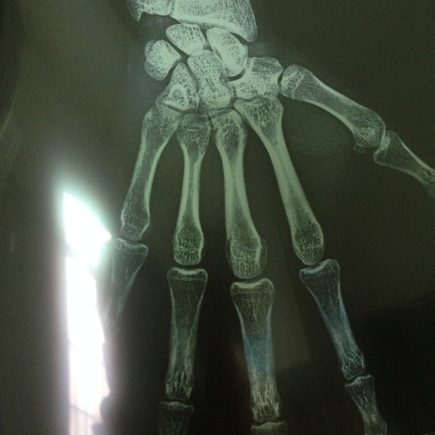 男 20岁 大家帮忙看一下我的骨骼线闭合没有?