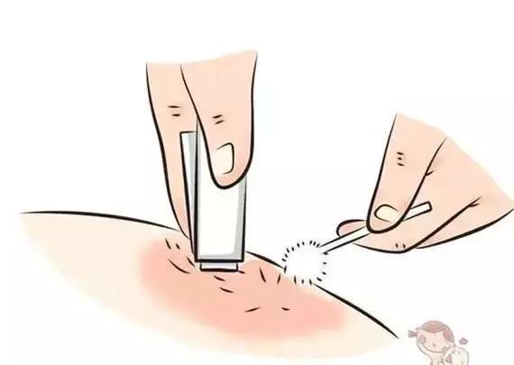 当水疱破裂,暴露出下面红色的嫩肤时,请用无菌不粘纱布覆盖在软膏层