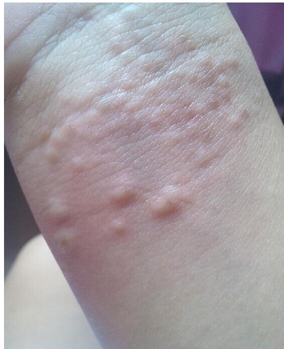 我左手手腕上也长过这种痘痘一样的东西。痒得