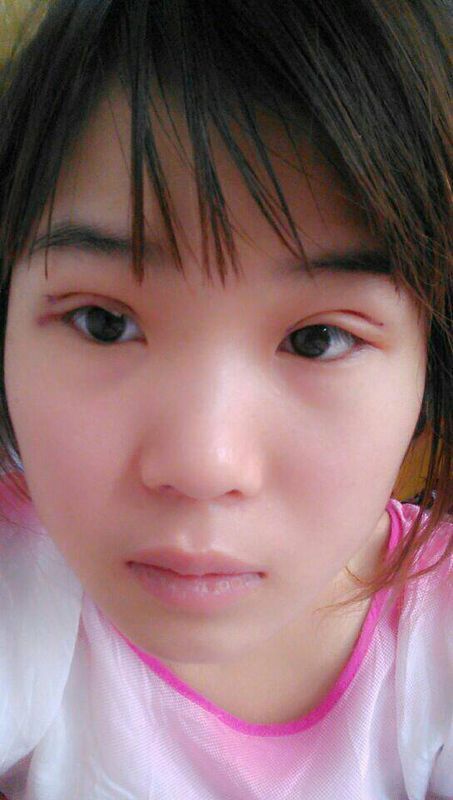 我十月一号下午3左右做的切开双眼皮,现在是第三天,我感觉两只眼睛做的形状和大小都不一样。请问这样是_360问答