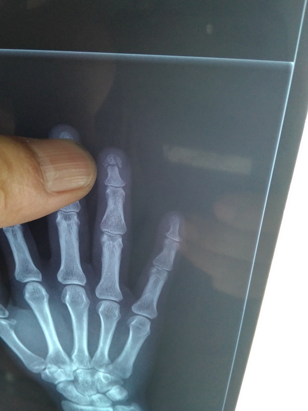 左手无名指末节指骨折 能评上等级吗