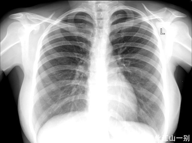 胸片能诊断肺癌吗为什么非得做昂贵的CT及很