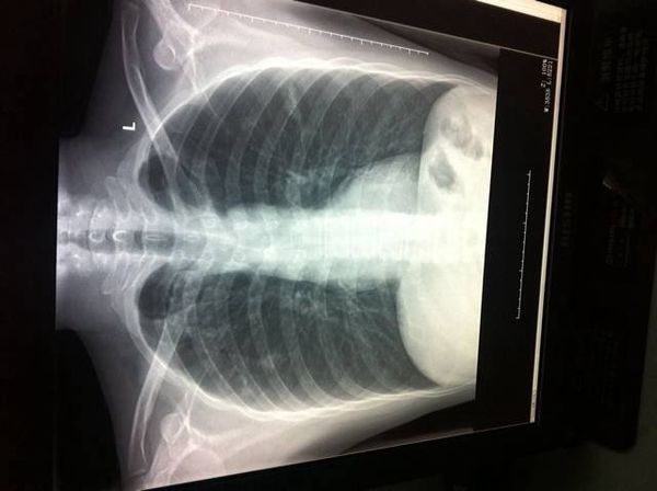 前3个月拍的胸片说是肺结核,吃3个月药片子一