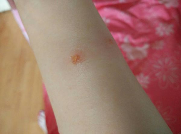 我被毒蚊子咬了,肿得厉害而且还流黄水,怎么办