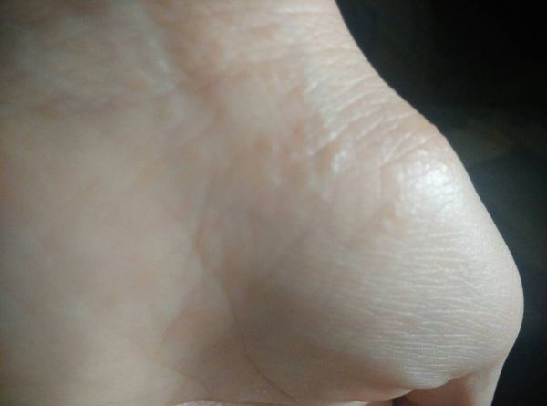 手心手掌里长有透明小水泡 开始会痒 时间久了