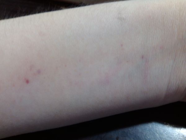 手臂上生出紫红色的小点,想知道是什么原因?需