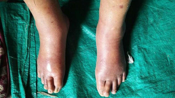 老人脚肿如图,80岁了,啥原因,有何方法,_360问