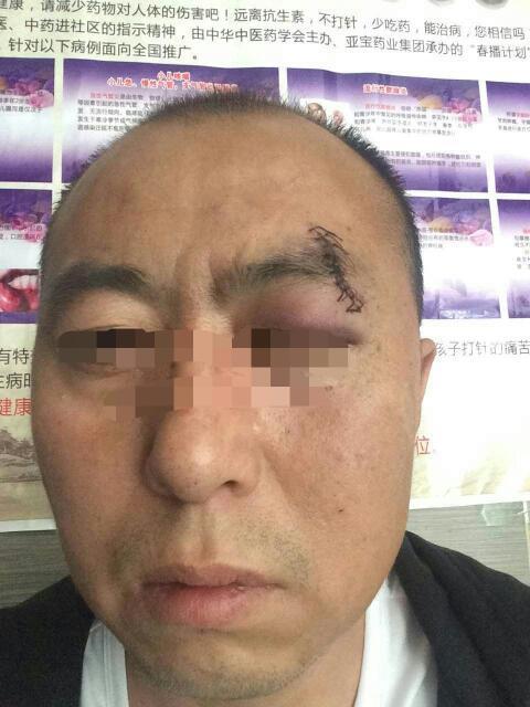 朋友用拳头把人打了,缝了11针,眼睛没有问题,请