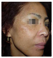梁春霞面部色斑是由于皮肤黑色素的增加而形成的一种常见面部呈褐色