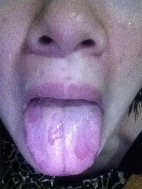 齿痕舌主要代表脾失健运