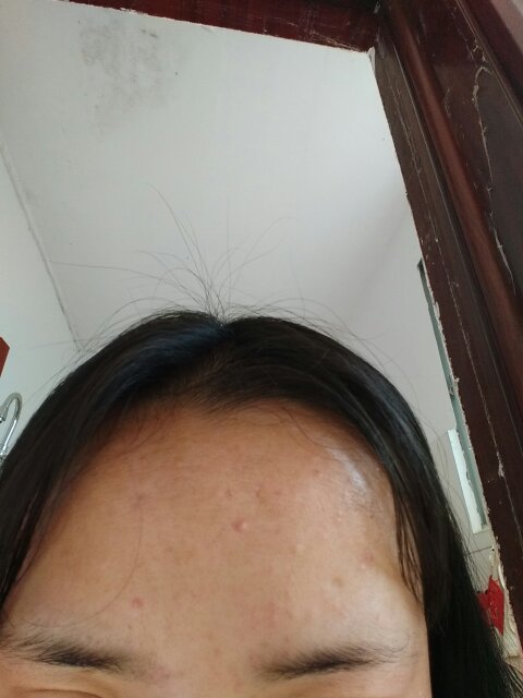嘴巴上面有痘印 额头有痘痘 皮肤容易脱皮 容易