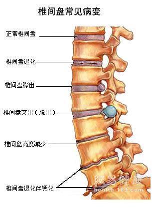 l5 s1椎间盘向椎体后缘突出;钙化;脊髓及双侧神经根受压怎样治疗
