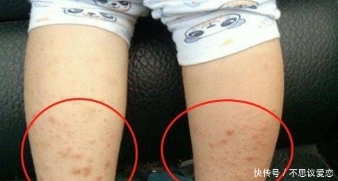 3岁儿子全身螨虫过敏,婆婆把 它 涂在红疹处,不