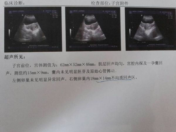 B超、早孕检查、右卵巢内18mm*14mm不均质