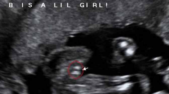 从唐氏筛查、B超、四维彩超可判定胎儿性别,