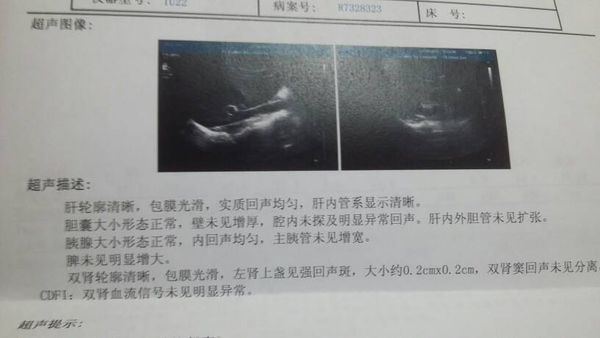 B超检查结果:双肾轮廓清晰,包膜光滑,左肾上盏