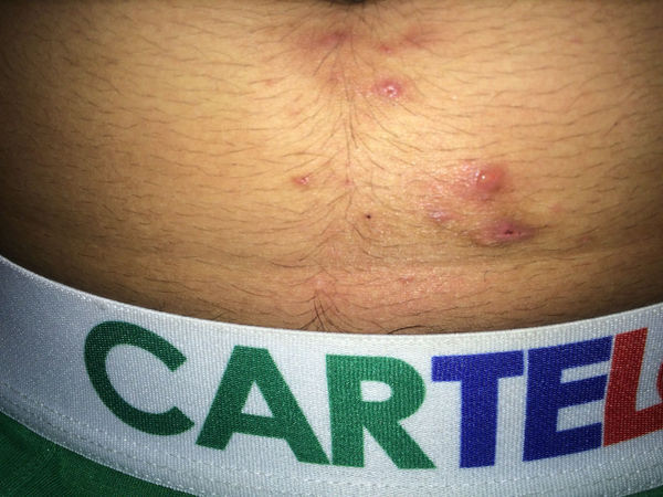 小肚子上面长了一块体癣,已经有好几年了,擦药了好了 还是会反反复复的复发,大家帮我看下究竟是什么癣_360问答