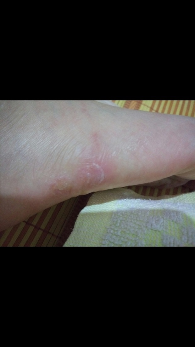 脚上夏天一直长水泡,伤口处血管颜色变了。_3