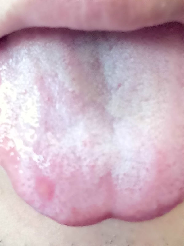 舌头有一片区域泛白,喝热水,辣的东西,会伴随刺