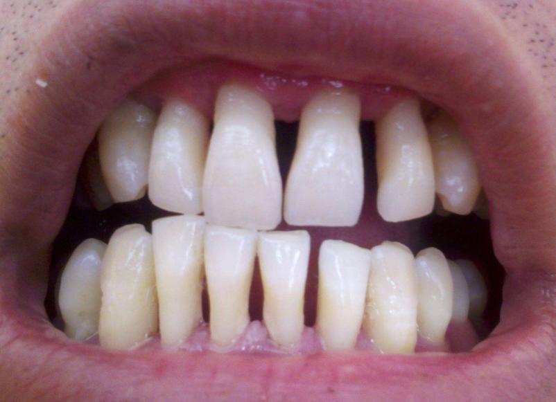 病理情况下,牙龈高度慢慢降低,组织发炎,牙缝变大.