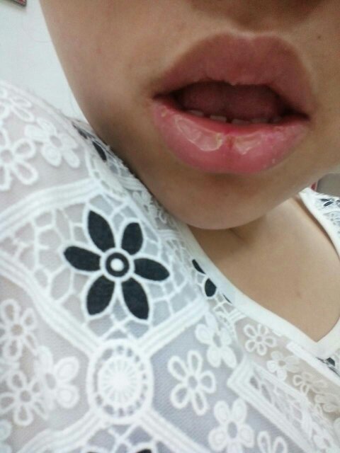 为什么 晚上不吃 减肥期间 嘴巴老是干的起皮 裂