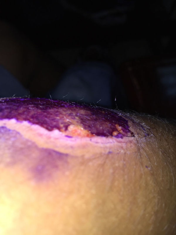 骑车擦伤。开始去诊所给用的百德邦加养肤的药