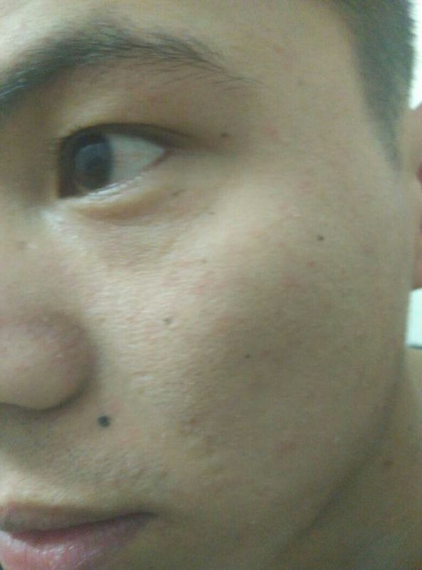 脸上的这个痣怎样去掉? 去美容院可以吗? 去掉