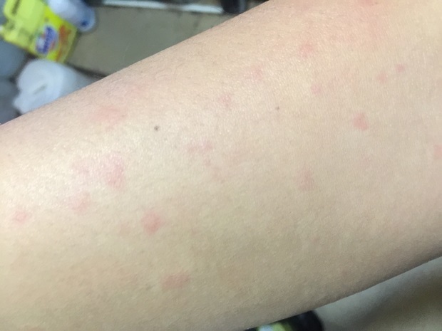 一到中午或者下午全身都有点痒,有点像过敏一