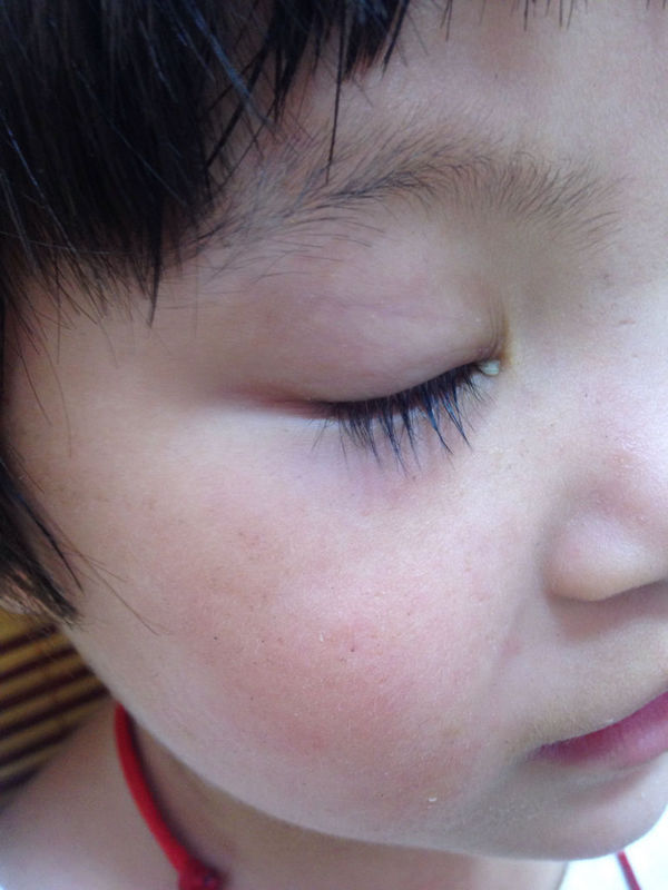 3周岁孩子眼睛发红,而且还有很多眼屎,是什么