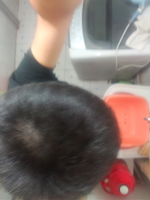 为什么后脑勺位于<em>旋</em>的位置<em>头发</em>稀疏,是不是因
