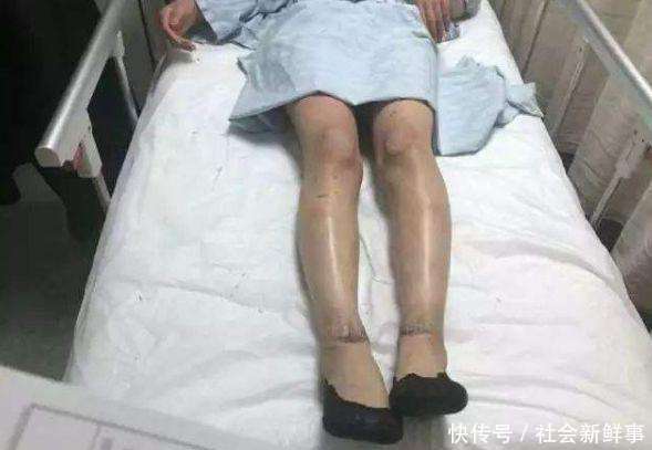 一女子做完鱼疗后，腿部开始痛痒难耐，去医院检查后她立马报警