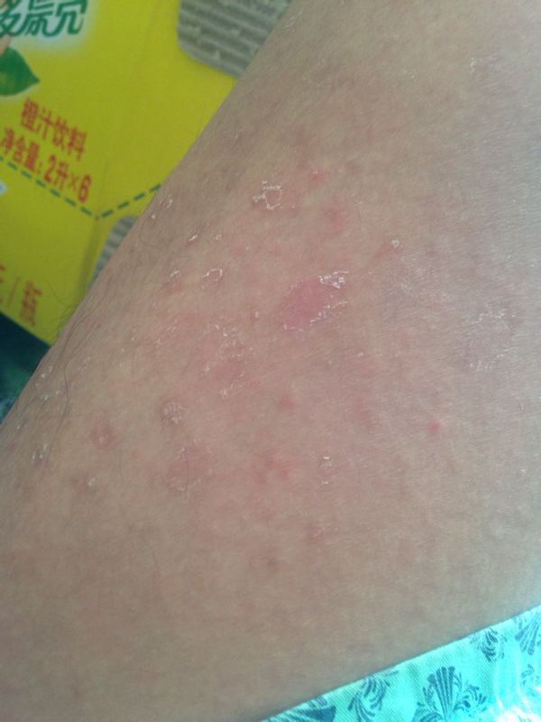 最近大腿内侧长了一点大红点,一点也不痒,不痛