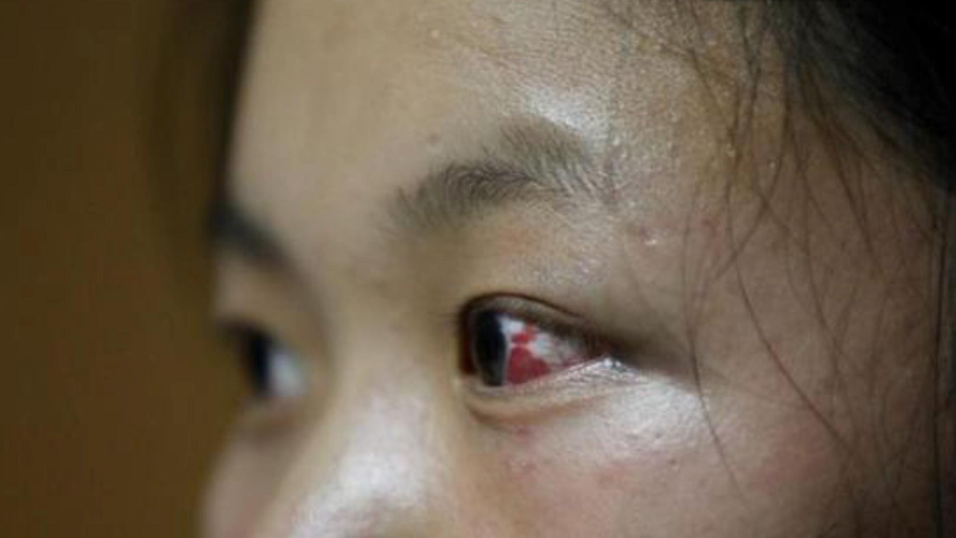 深圳15岁女生被同学群殴1小时 眼睛充血浑身伤