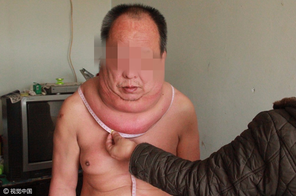 【转】北京时间 53岁男子得怪病 脖子周长97厘米起床困难易摔倒 - 妙康居士 - 妙康居士~晴樵雪读的博客 【转】北京时间 53岁男子得怪病 脖子周长97厘米起床困难易摔倒 - 妙康居士 - 妙康居士~晴樵雪读的博客