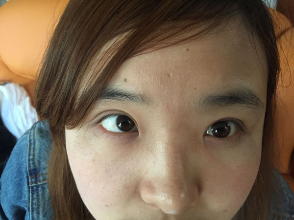 做的埋线双眼皮吸脂了,眼泡总是肿,双眼皮那是