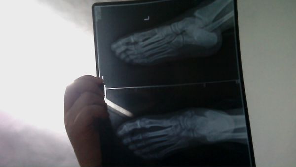 14岁女练拳击的,崴脚一个月了,运动疼,x光征相