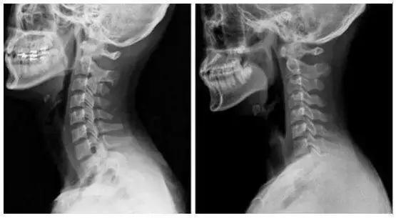 正常人到颈椎变形的图片_360问答