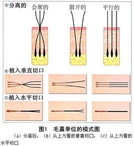 植发能彻底根治脂溢性皮炎吗