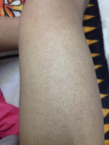 大腿上长了很多这样的红疹 不痛不痒 很久了 好